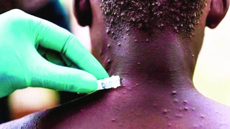 El país confirma seis casos de viruela símica y descarta 19 sospechosos en lo que va de año